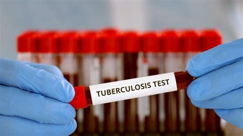 cvs tuberculosis test|Testing for Tuberculosis: Blood Test .